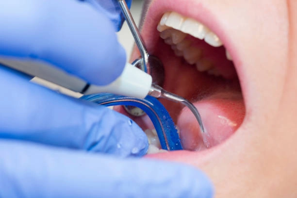 Dental procedure in progress with tools, gloves, and patient’s mouth. -dental deep cleaning vs regular cleaning