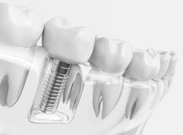 Explore the differences between dental implants vs dentures, including costs, durability, and maintenance, to choose the best option for your smile.-dental implants vs dentures