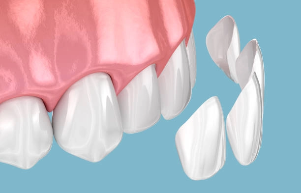 Porcelain veneers being applied to improve teeth's appearance and alignment. -dental veneer cost