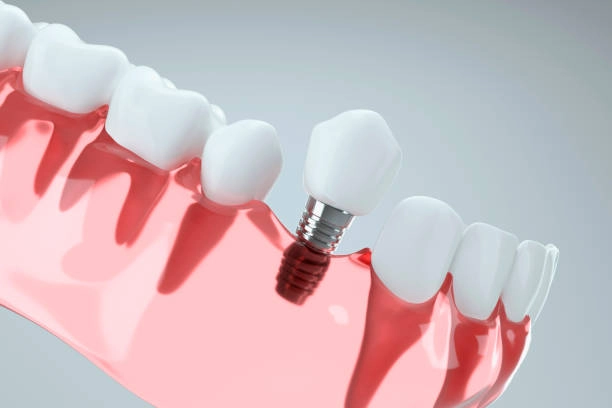 Dental implant illustration showing titanium post supporting a crown replacement. -dental implant types