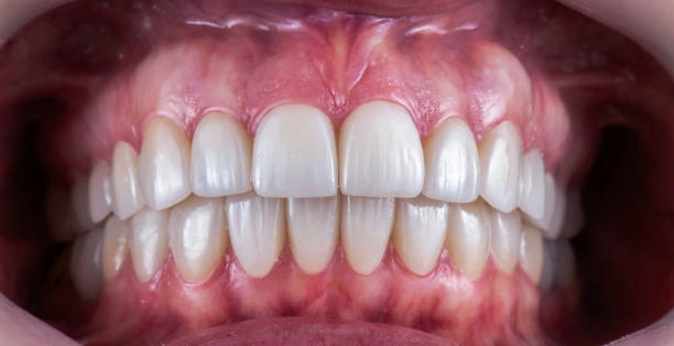 Close-up of a healthy, clean, straight smile showing white teeth. -cosmetic dentistry dentist